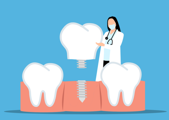 Имплантация зубов : что это и как работает ?