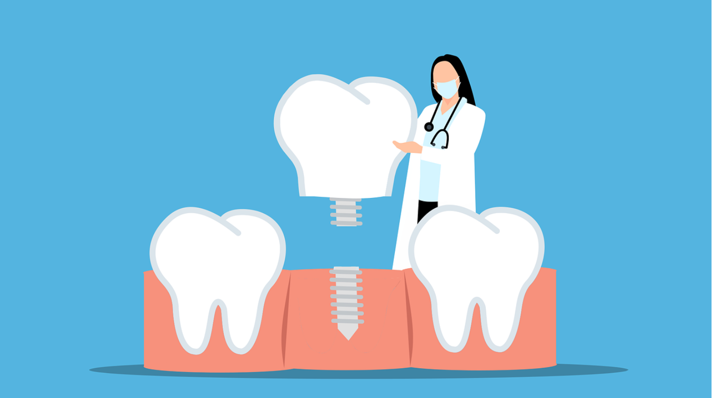 Имплантация зубов : что это и как работает ?